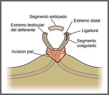 vasectomia sin bisturi coruña lugo ferrol